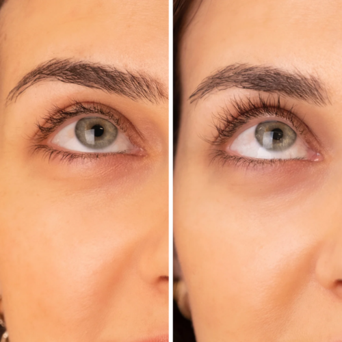 Bimatoprost before and after results