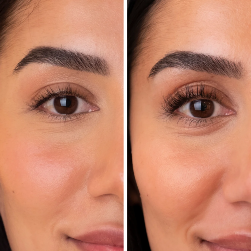 Bimatoprost before and after photos
