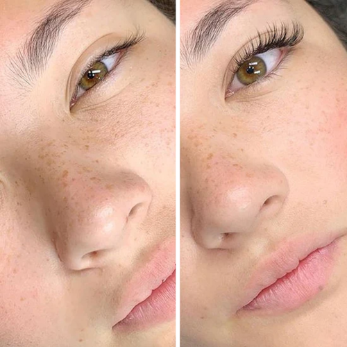 Careprost Before After
