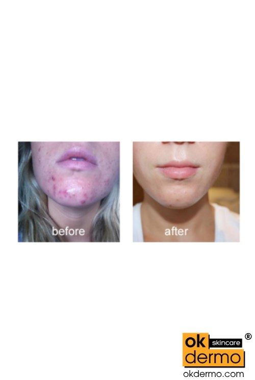 Retin a acne treatment before after