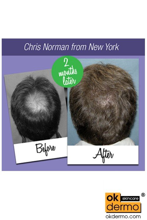Qilib® Rebalance Hair Fall Cycle Lotion | OKDERMO Skin Care