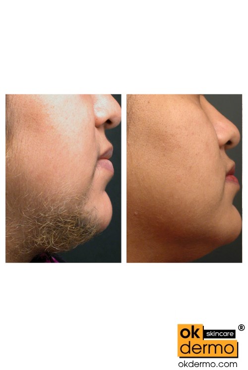 Eflornithine Cream The Ultimate Solution for Facial Hair OKDERMO