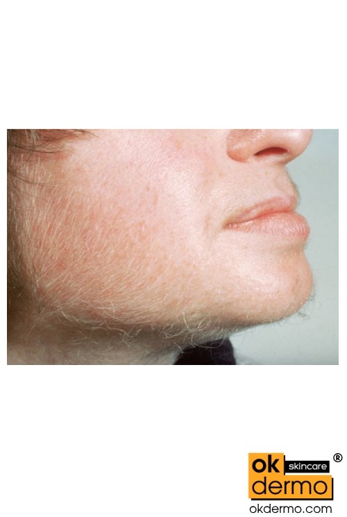 Eflornithine Cream The Ultimate Solution for Facial Hair OKDERMO