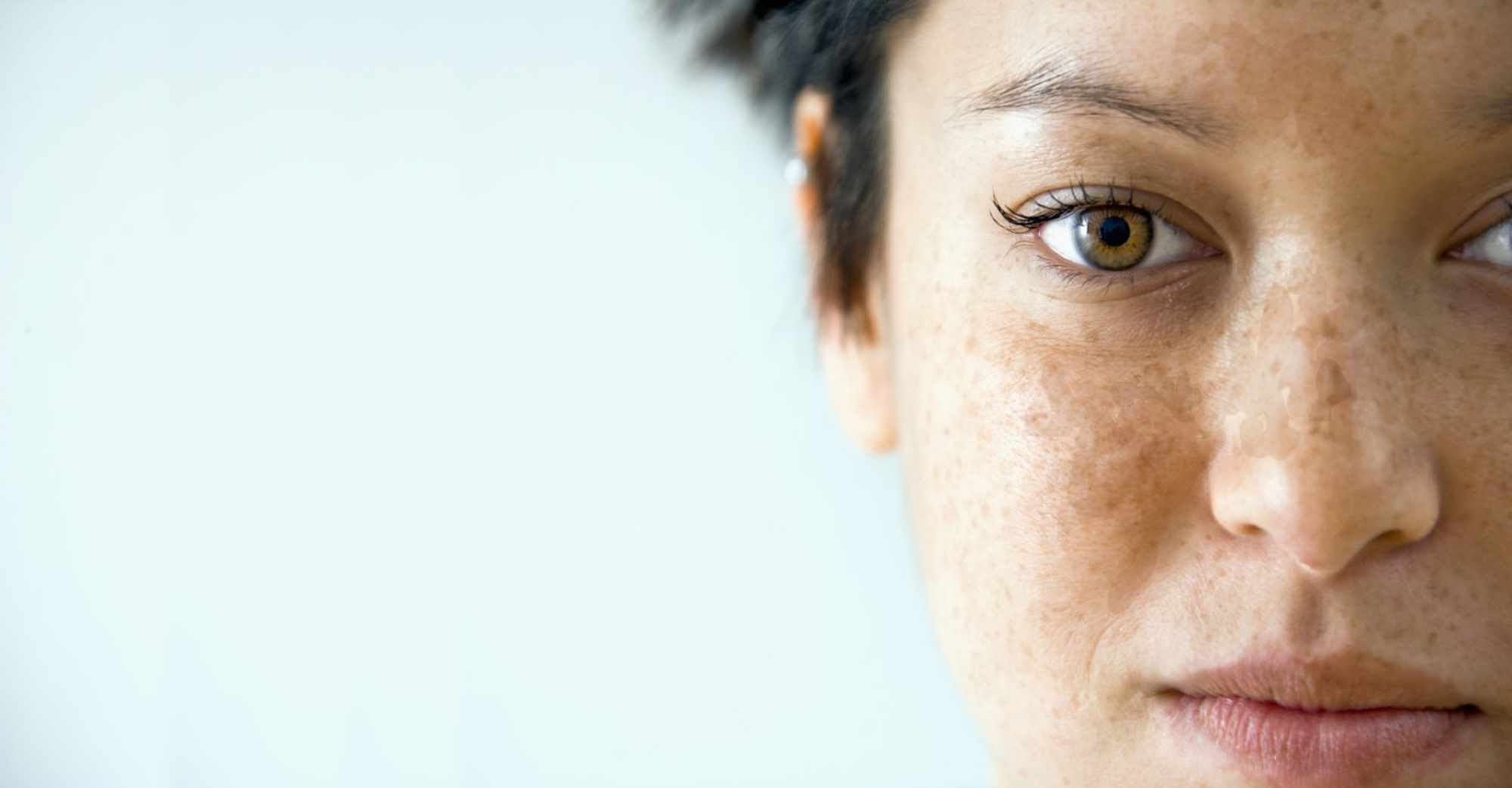 Skin lightening hyperpigmentation dark spots discoloration chloasma freckles