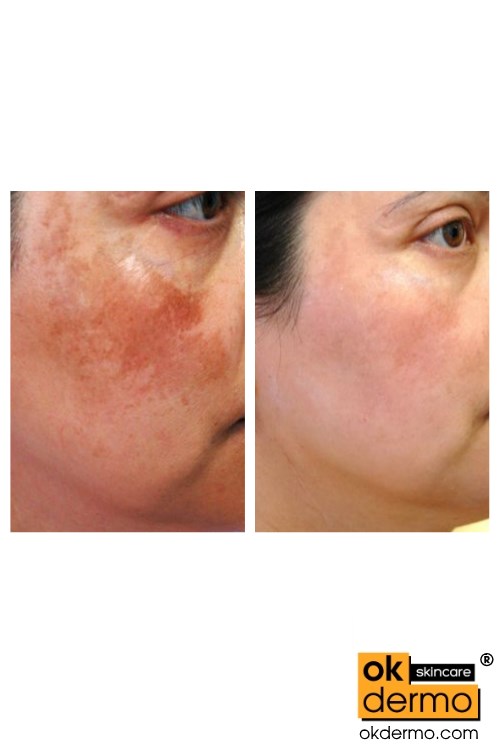 Hydroquinone Cream For Acne Scars In India - All The Best 