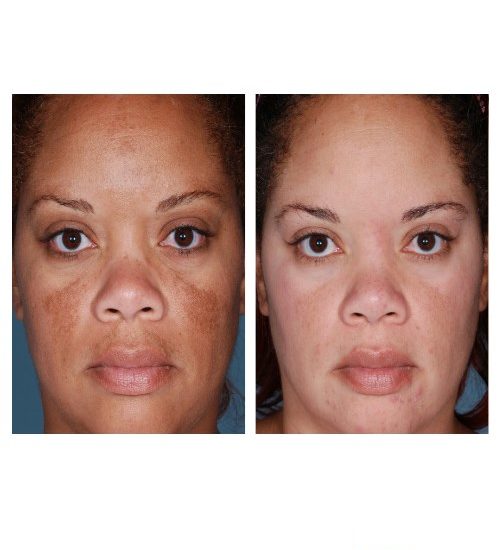 Hydroquinone Before And After Black Skin | www.pixshark 