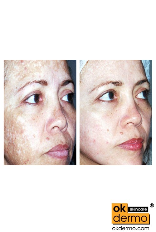 hydroquinone cream before after