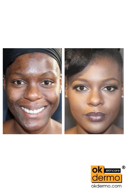 kojic acid before and after