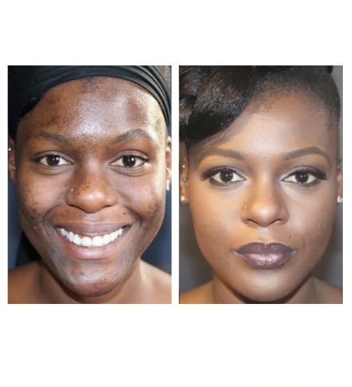 Hydroquinone Before And After Black Skin | www.pixshark 