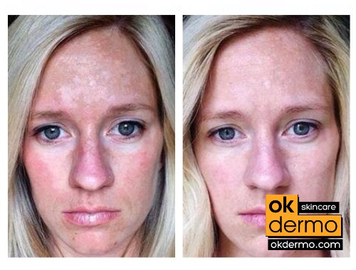 Hydroquinone Before And After Black Skin | www.pixshark 