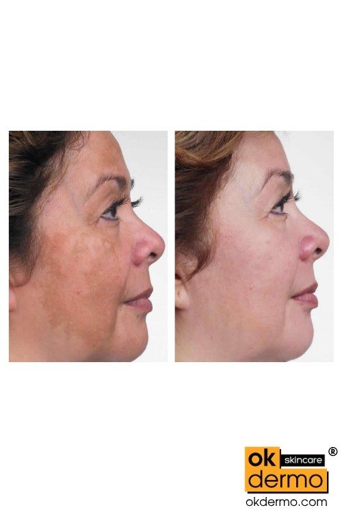 Hydroquinone cream before and after