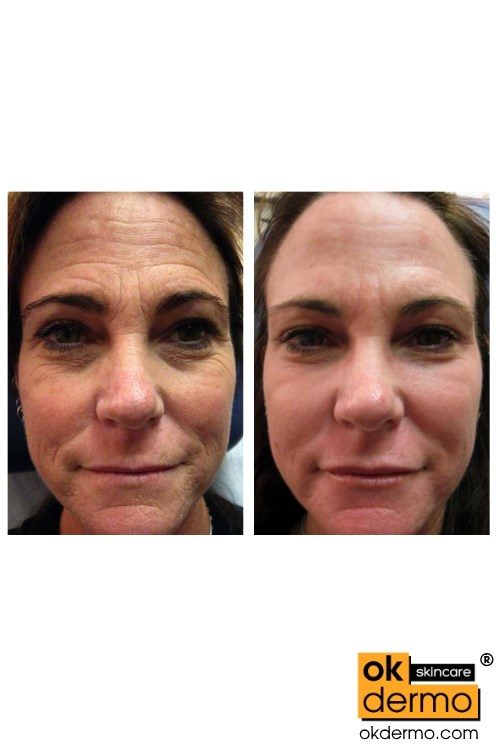 Anti Aging cream Botox Before and After