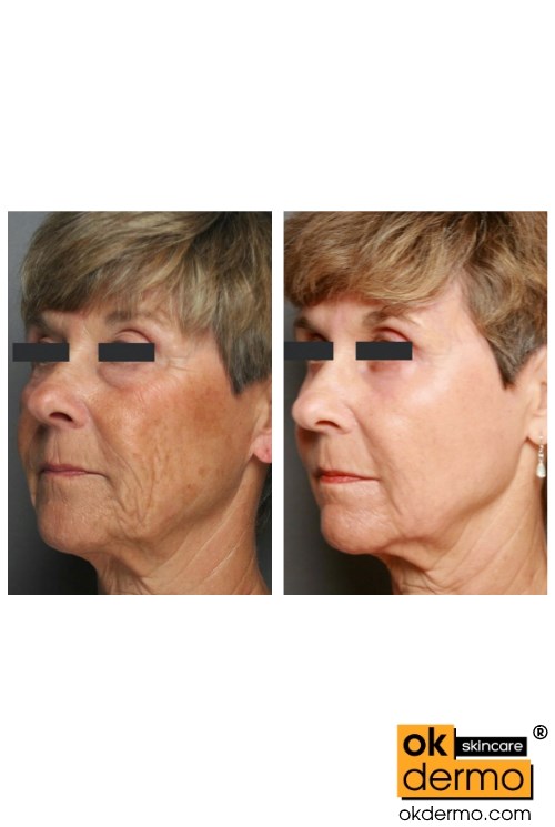 Retin a wrinkles treatment