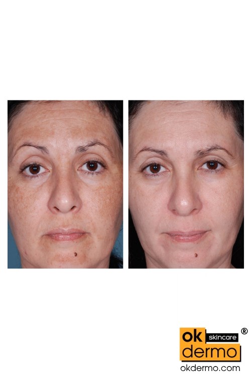 hydroquinone cream before and after