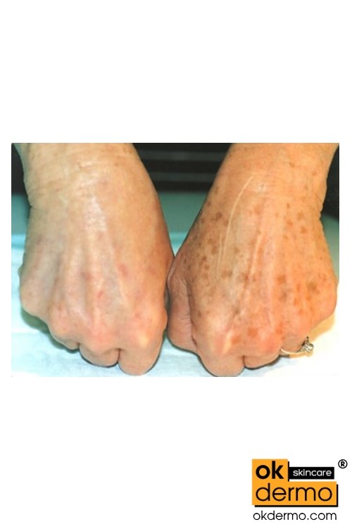 Hands before and after treatment Liver spot, Age spots