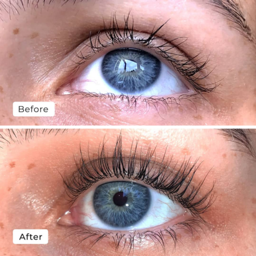 Careprost vs Lumigan results