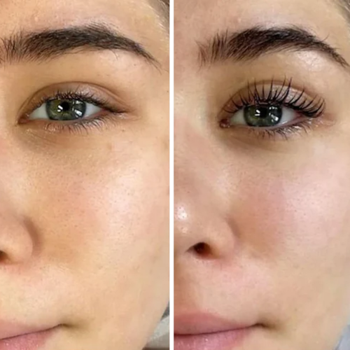 Bimatoprost Before After