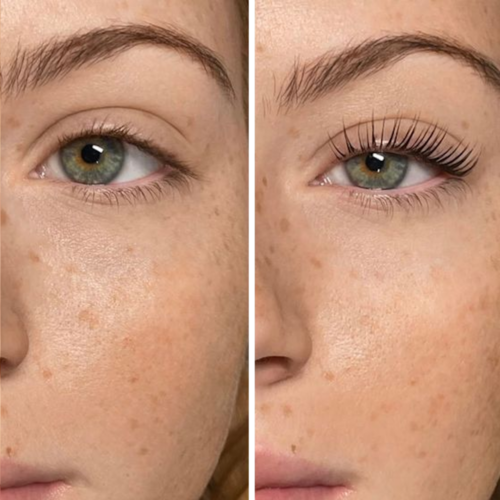 Latisse Before After