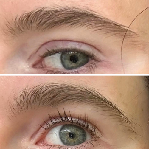 Bimatoprost Before After