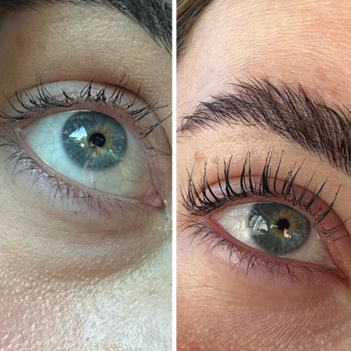Lumigan Before After