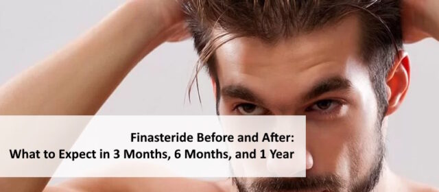 finasteride before and after