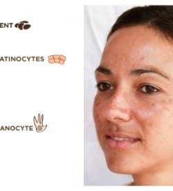 How To Use Hydroquinone Topical Creams