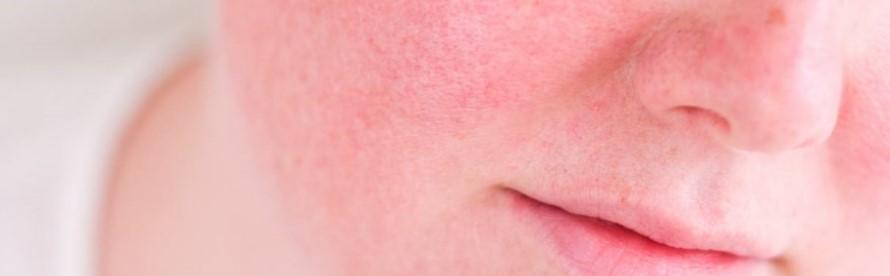 How to Minimize Irritation & Redness With Retin-A
