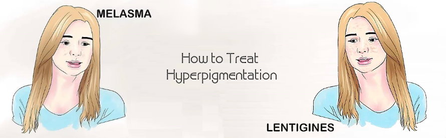 How to Treat Hyperpigmentation Melasma