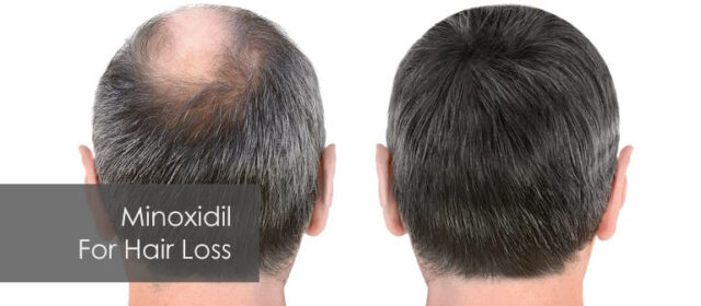 what is minoxidil used for