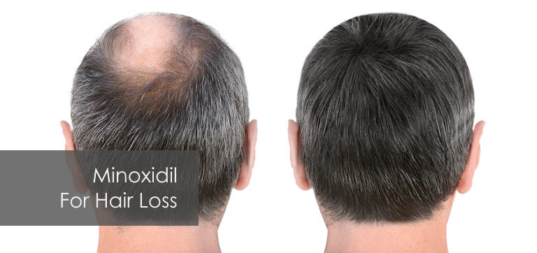 what is minoxidil used for