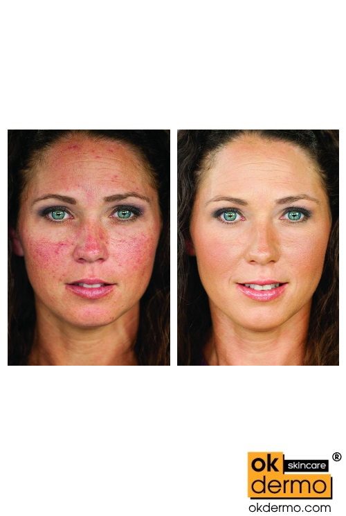Soolantra before and after treatment Rrosacea ivermectin cream for rosacea soolantra coupon soolantra over the counter ivermectin cream
