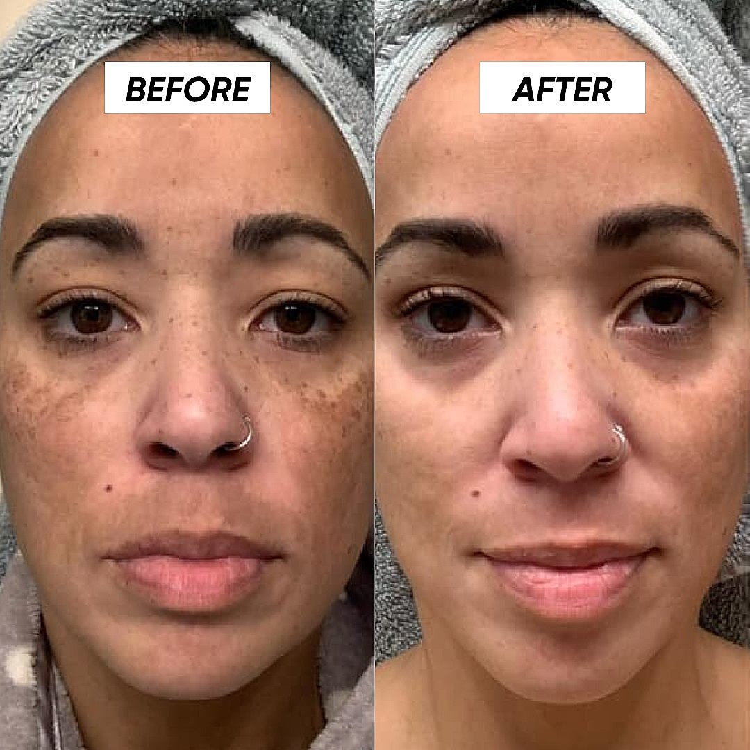 Before and After Tretinoin