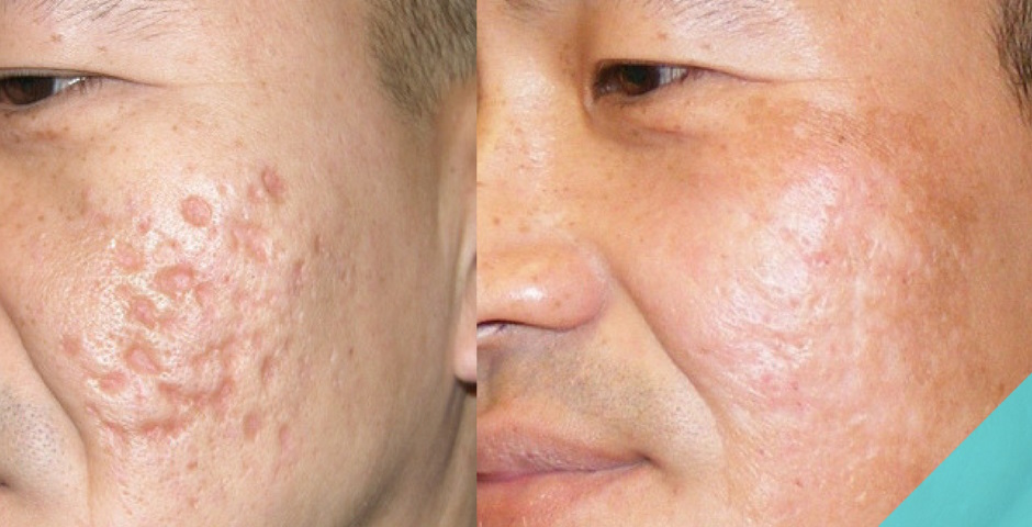 contractubex gel uses for acne scars