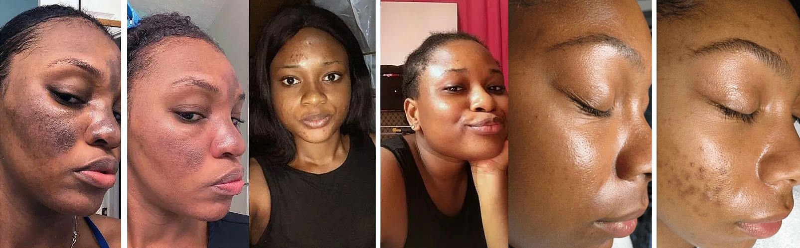 hyperpigmentation kojic acid soap before and after photos 