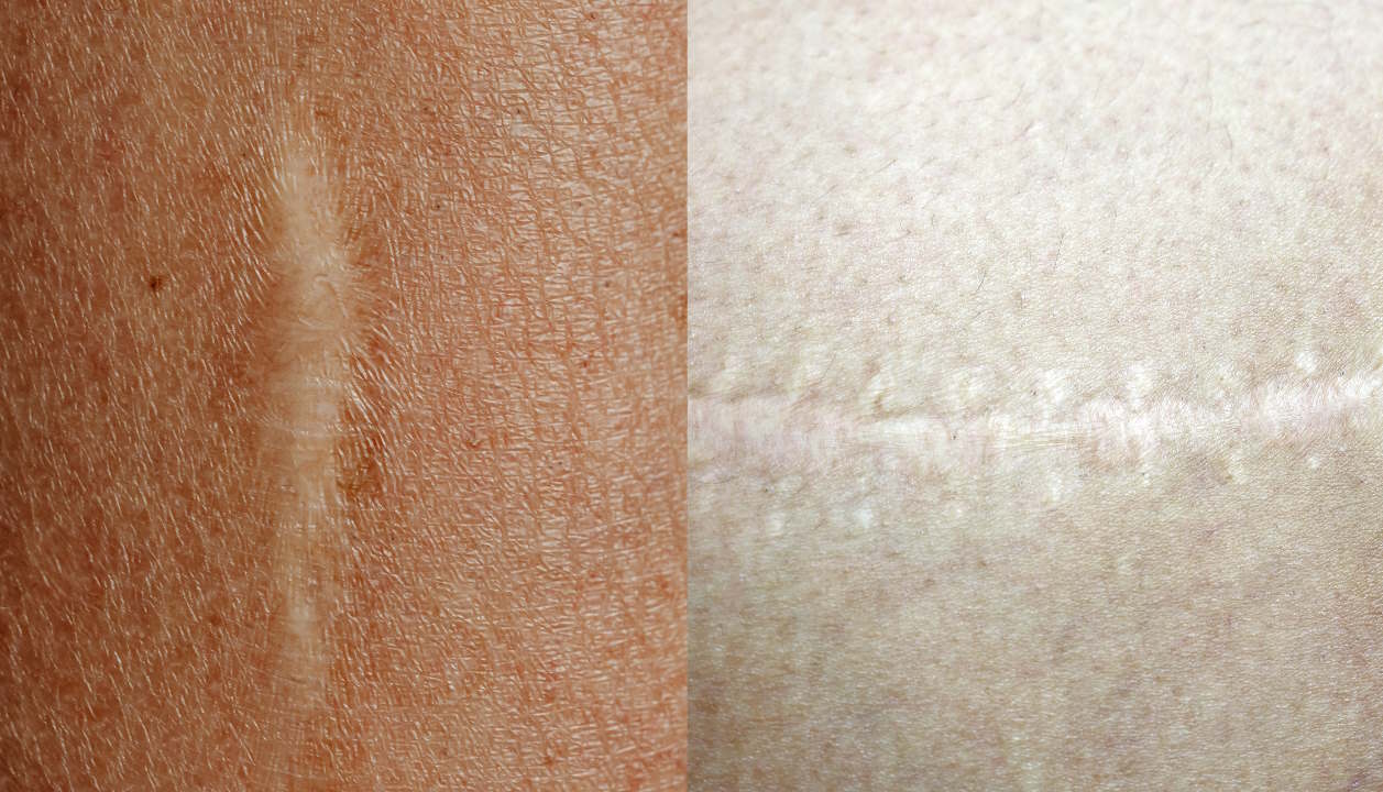 hypopigmented scars treatment