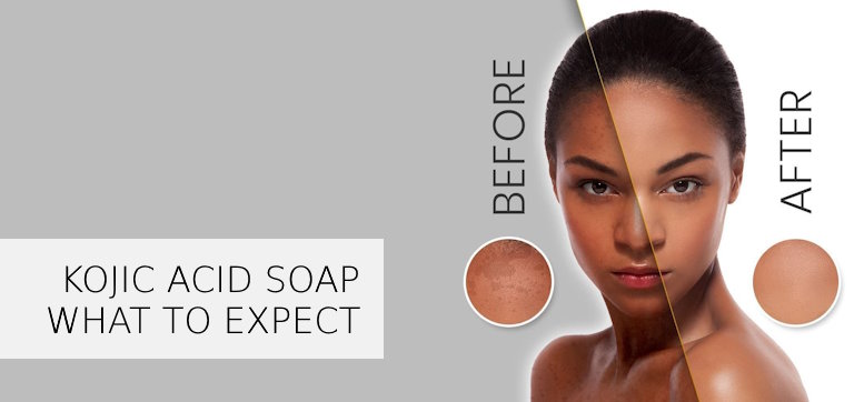 hyperpigmentation kojic acid soap before and after photos