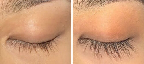 Does Latisse really work? Before and after photos