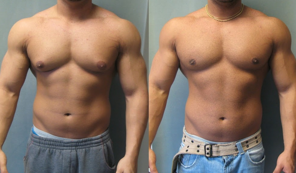 raloxifene for sale, gyno raloxifene before after