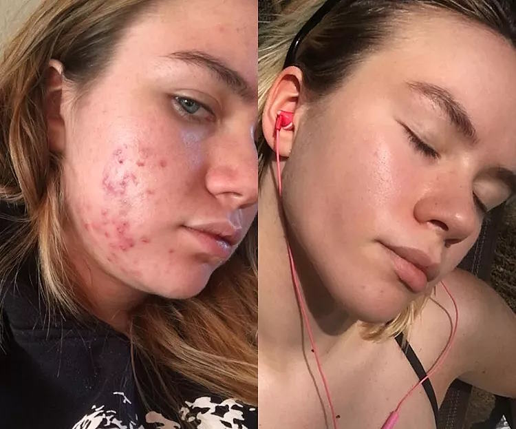 how long does spironolactone take to work for acne